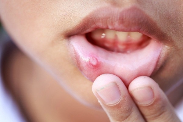 Oral Cancer Treatment in Iran