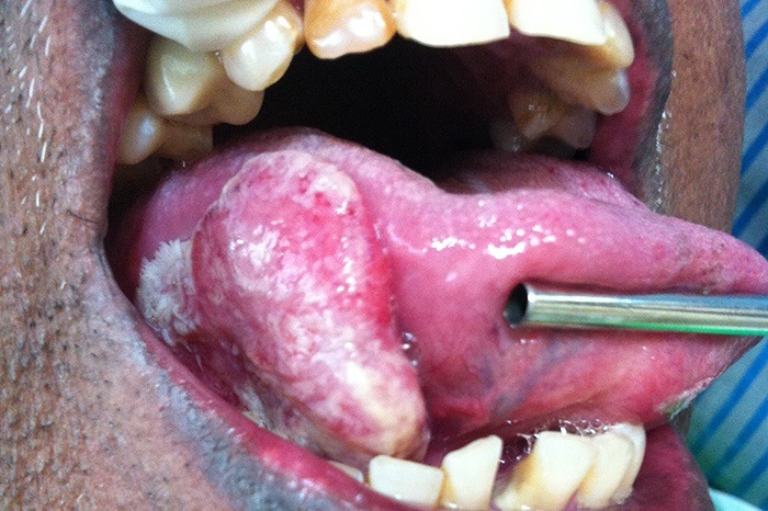 Oral Cancer Treatment in Iran
