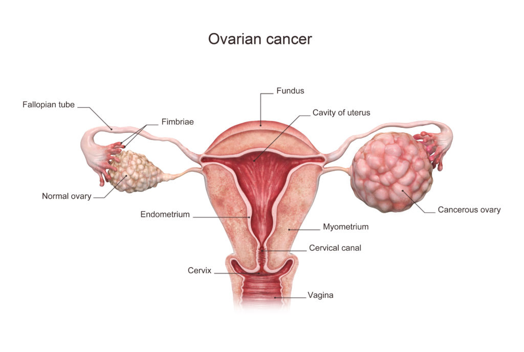 Ovarian Cancer Treatment in Iran