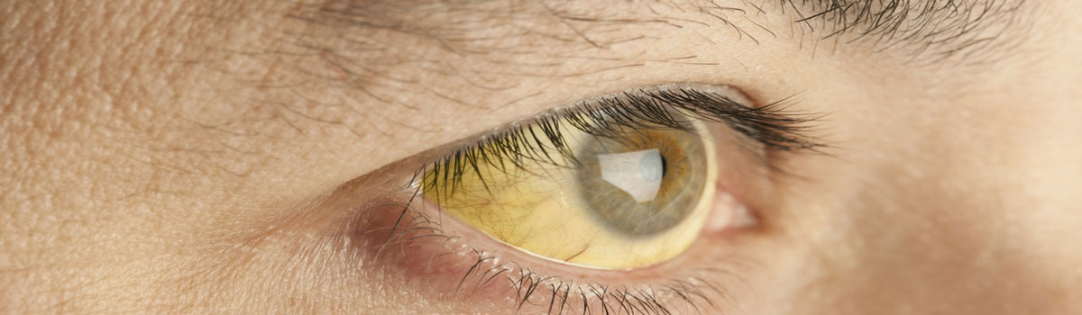 Retinoblastoma (Eye Cancer) Treatment in Iran