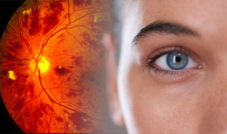 Retinoblastoma (Eye Cancer) Treatment in Iran