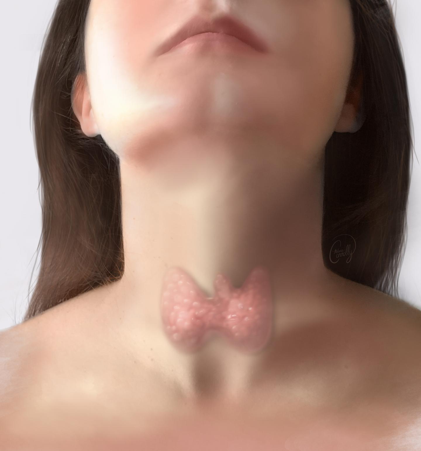 Thyroid Cancer Treatment in Iran 