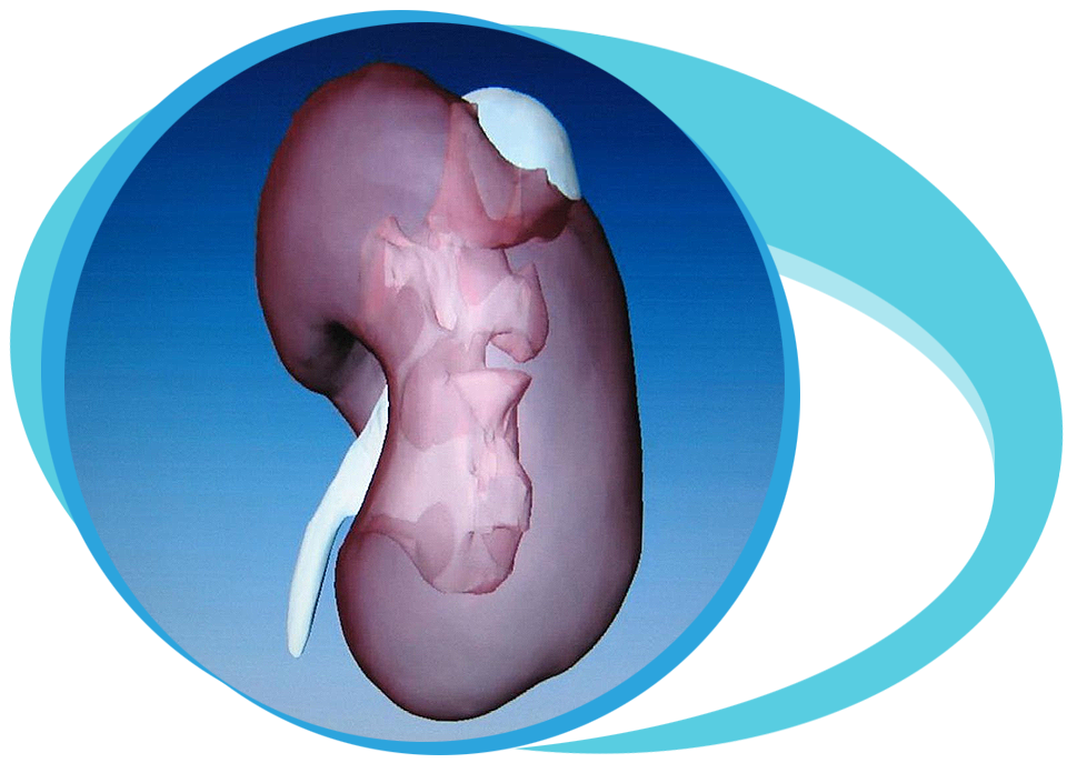 Kidney tumor ressection in Iran