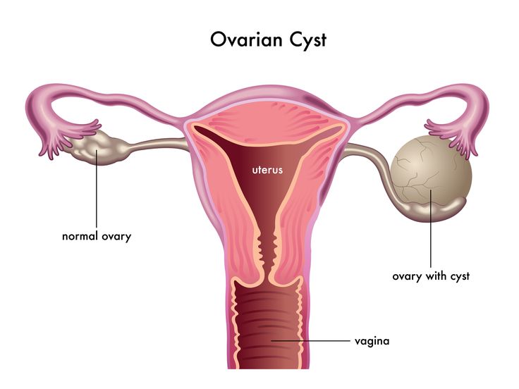 Ovarian cyst in Iran