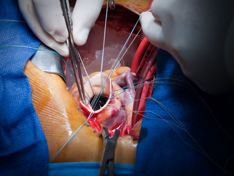 Repair of the heart valve